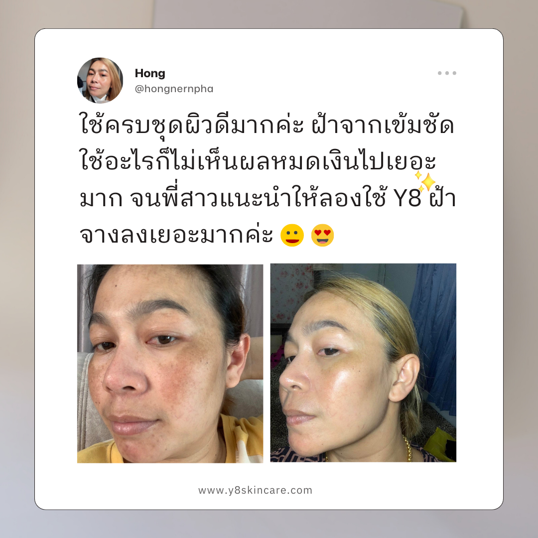 Y8 ดีไหม Y8 ดีจริงไหม รีวิวจากคนใช้จริง ฝ้าหนา ครีม Y8 แก้ฝ้ากระ สิว ผิวติดสาร  